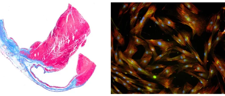 Cardiac tissue fibrosis stained with Masson's trichrome on left and fluorescently labeled cardiac fibroblasts on right.