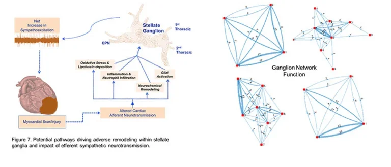 Illustration of how myocardial injury leads to adverse remodeling in the stellate ganglia. 