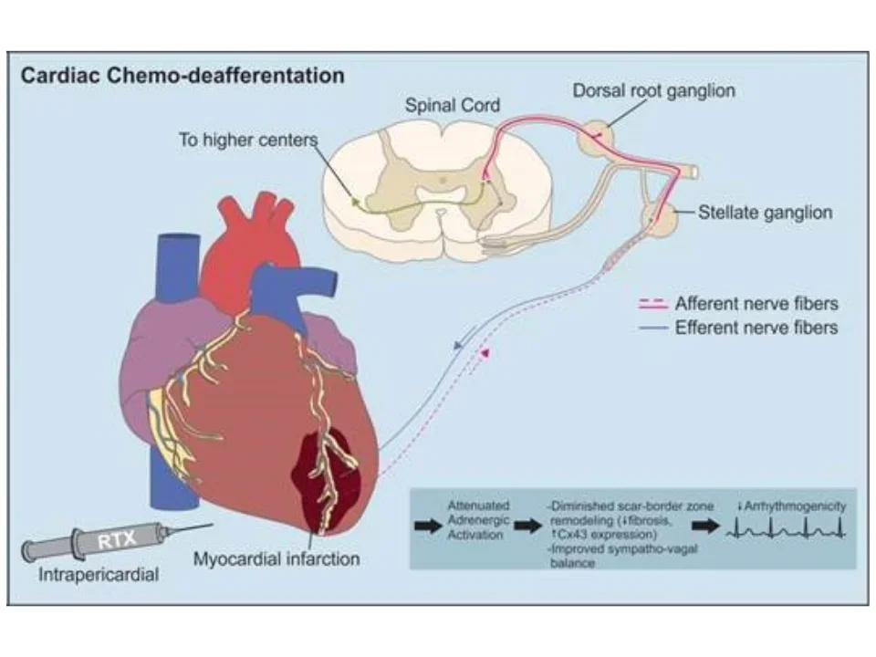 Panels comparing intact vs. chemically deafferented cardiac nerve signaling after myocardial infarction.